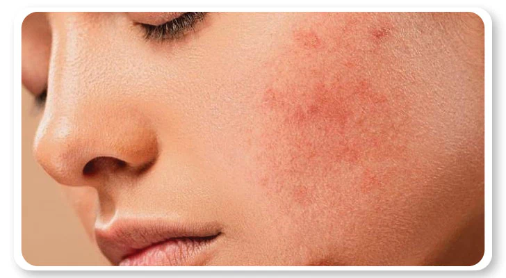 Remove-Itchiness-and-Acne